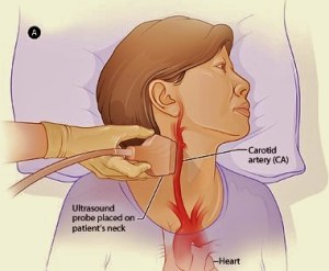 carotid